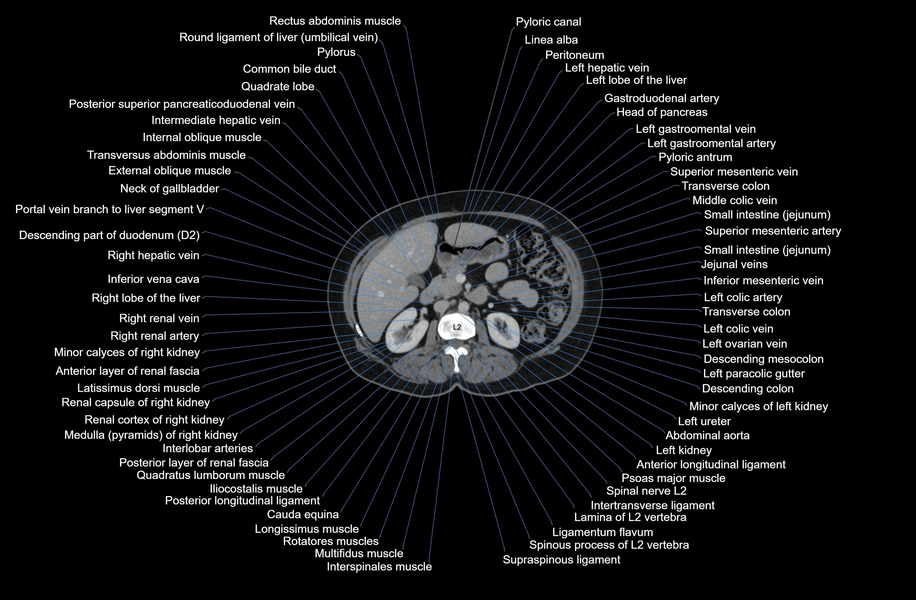 CT Abdomen axial cross sectional anatomy labelled radiology image-00036.webp